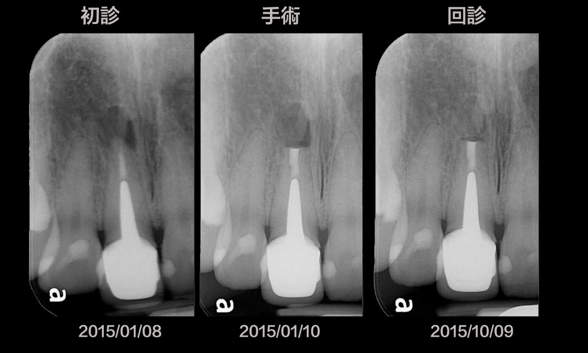 根尖手術與重新根管治療 為什麼優先選擇根尖手術 高雄根管治療專家 牙髓病專科王俊欽牙醫師