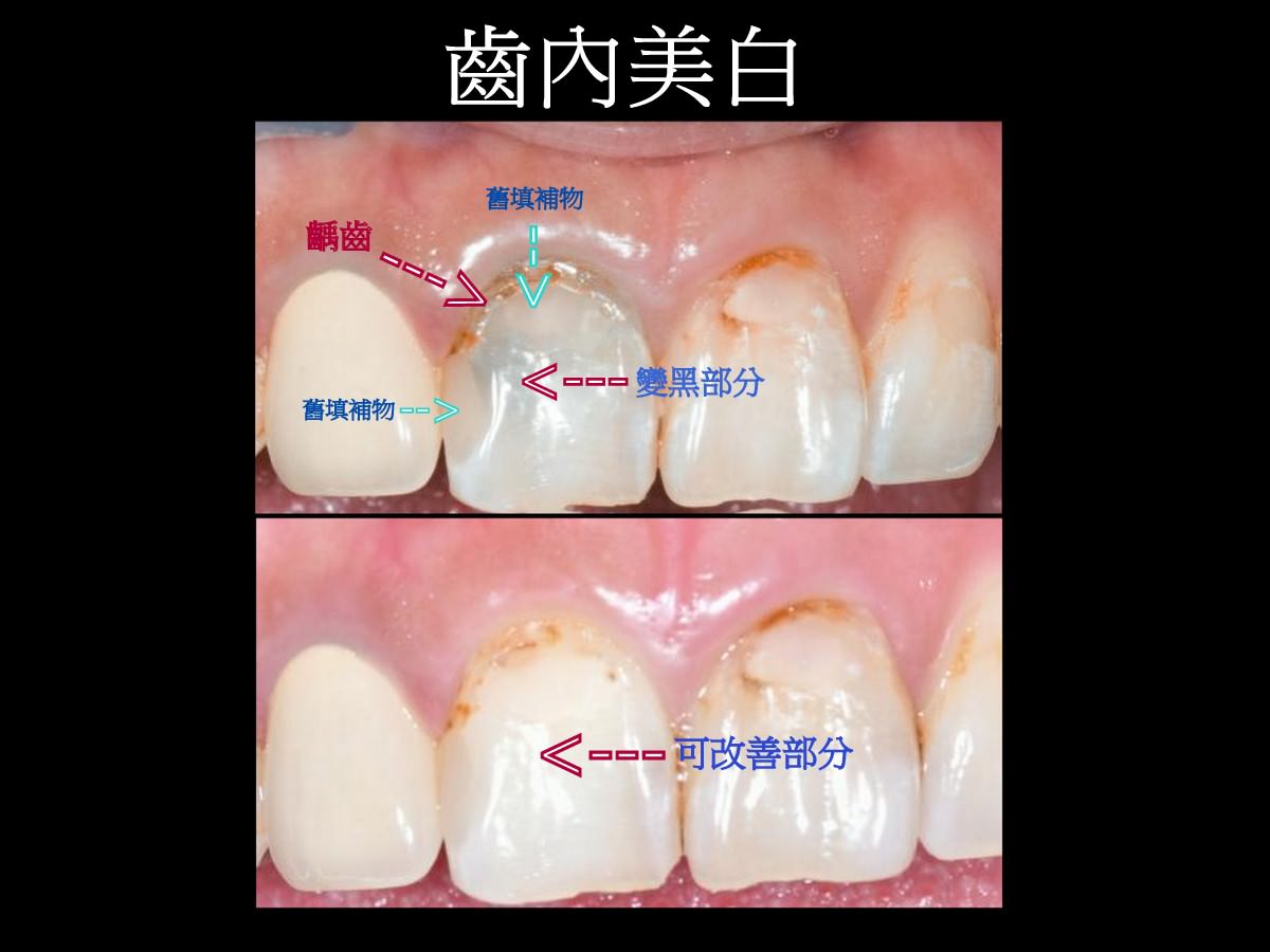 牙齒變黑了怎麼辦？part II：根管治療後，不只牙齒顏色變深，牙齦也黑黑的。 - 牙科美容資訊 - 美容牙科張凱榮醫師